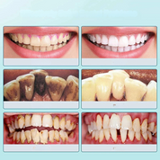 Immagine di denti prima e dopo lo sbiancamento dentale, mostrando miglioramenti significativi nella pulizia e nel colore. Risultati visibili e brillanti.
